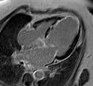 MRI na toediening van een contrastmiddel bij een patiënt die een hartinfarct heeft doorgemaakt.Het infarct wordt als helder wit afgebeeld.De rest van de hartspier is zwart