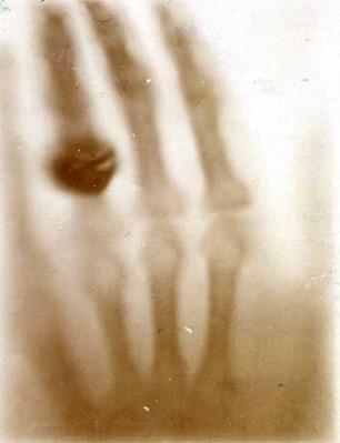 Dit wazig beeld is één van eerste RX-opnames van een mens ooit geproduceerd. Men zegt dat het de hand en trouwring is van Röntgen's vrouw, Bertha.
