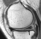 scheur meniscus